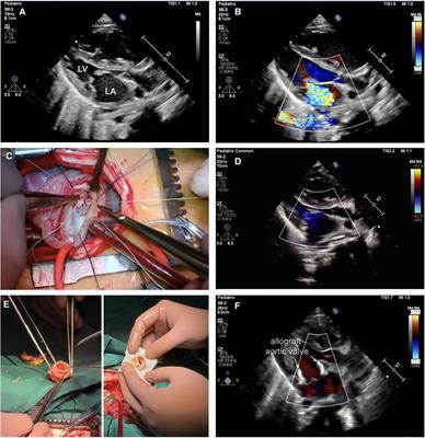 Case Report: Allograft aortic valve replacement in irreparable infant mitral valve